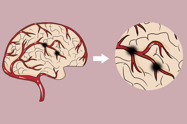 血压太低也会引发脑卒中？多少算低？身体的症状别忽视