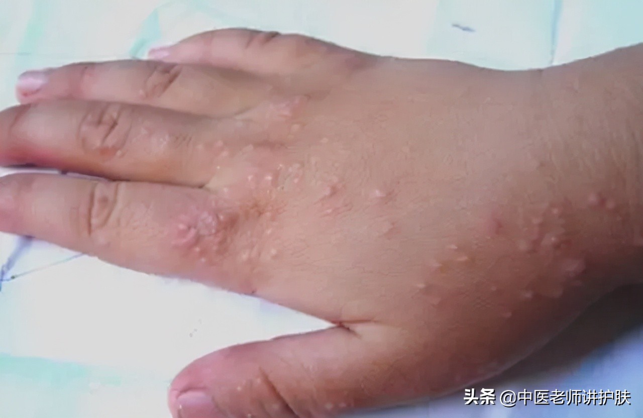 婴儿慢性湿疹(急性湿疹和慢性湿疹有什么区别) - 乐宝宝贝