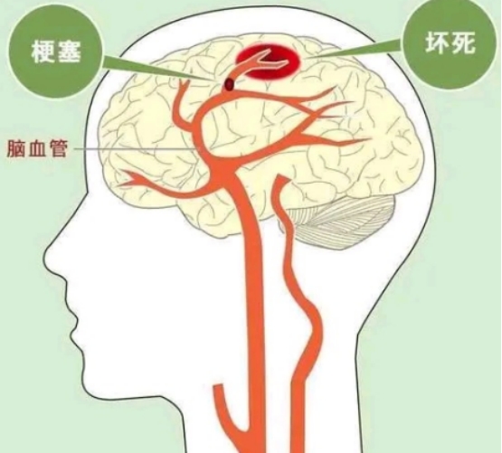 50岁后查脑CT，出现这4种问题，不需要特殊治疗，别被坑了