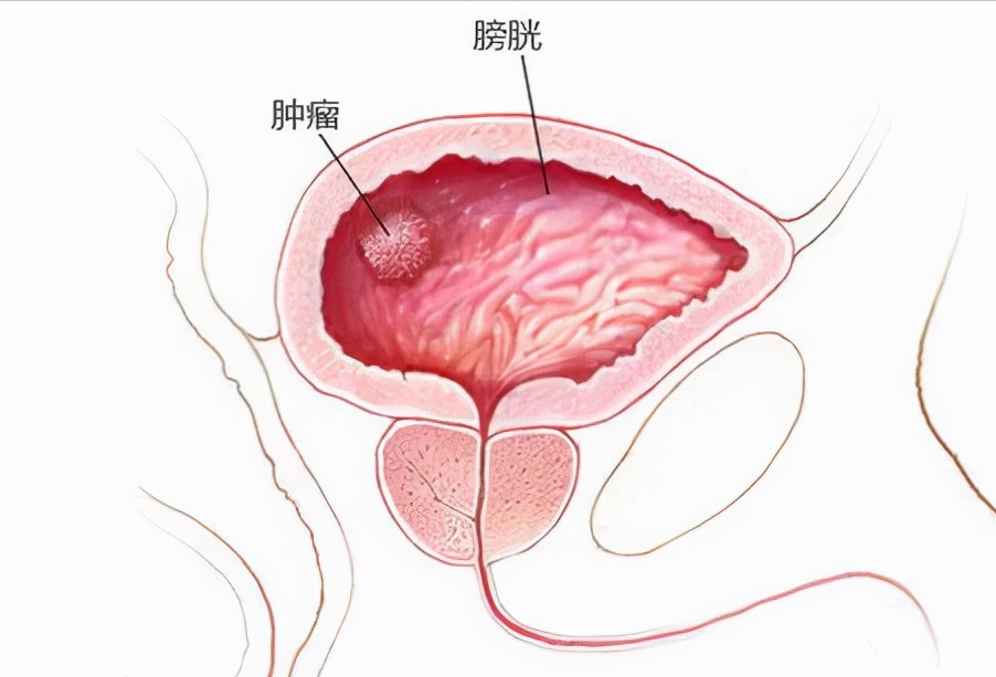 有无痛血尿可能是膀胱癌？医生提醒：可能还有三个常见的排尿异常
