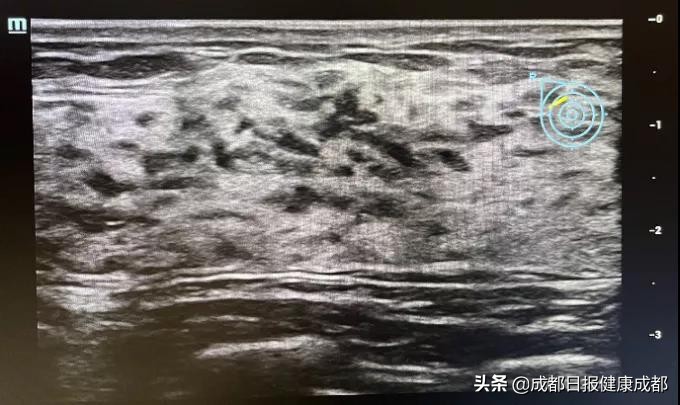 吓趴了！乳房胀痛甚至有硬物是不是得了乳腺癌？