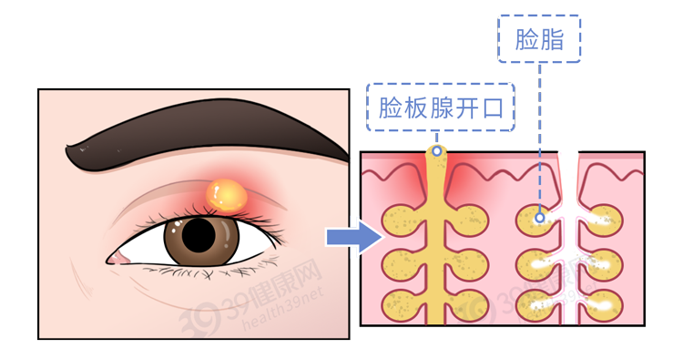 长了麦粒肿，怎么治疗好得快？一定要开刀吗？这几件事要记住