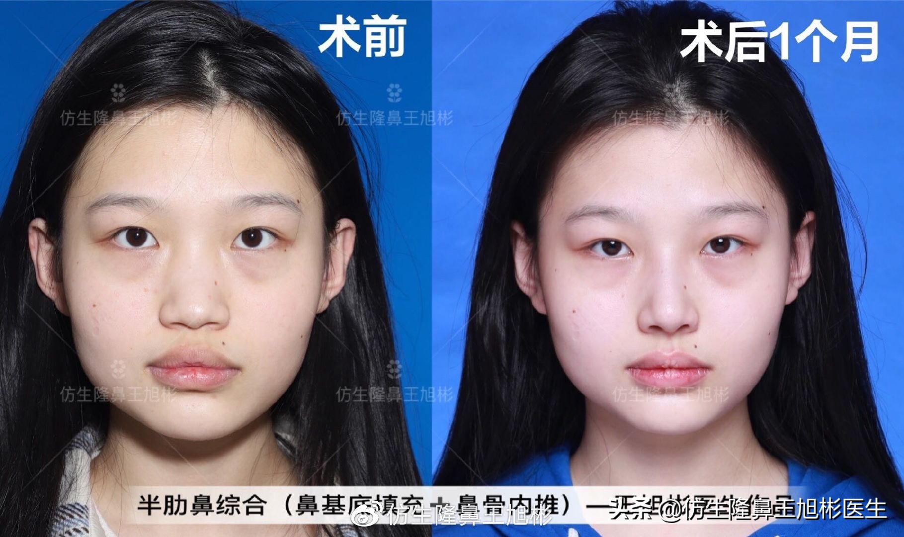 67鼻梁基底部也就是鼻骨宽,鼻骨与脸部的分界不清,糊成一片,也因而