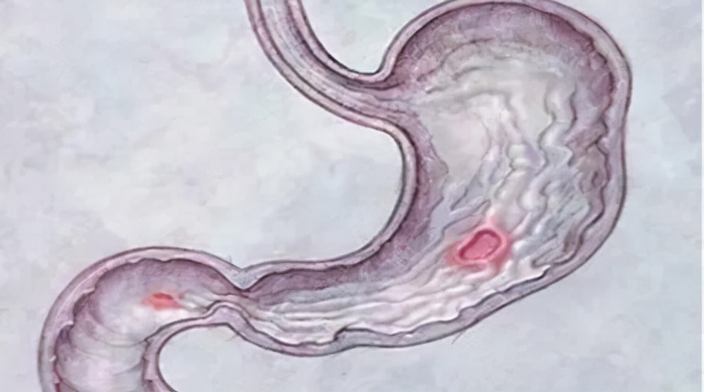 从胃炎到胃癌，需要几年？消化科医生说出实话，不妨查看一下