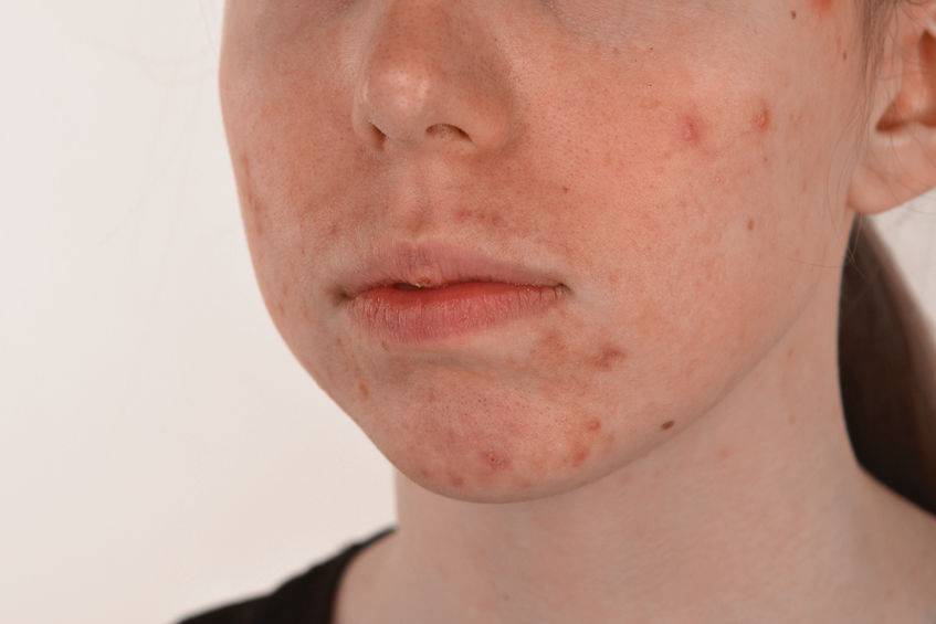 脸上反复长痘，或与这4个因素有关，找到诱因后，需针对治疗