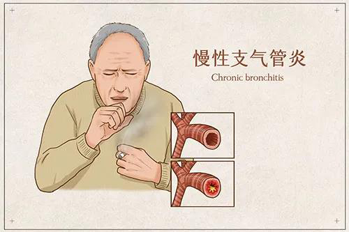 那麼,慢性支氣管炎的症狀有哪些,又如何治療呢?