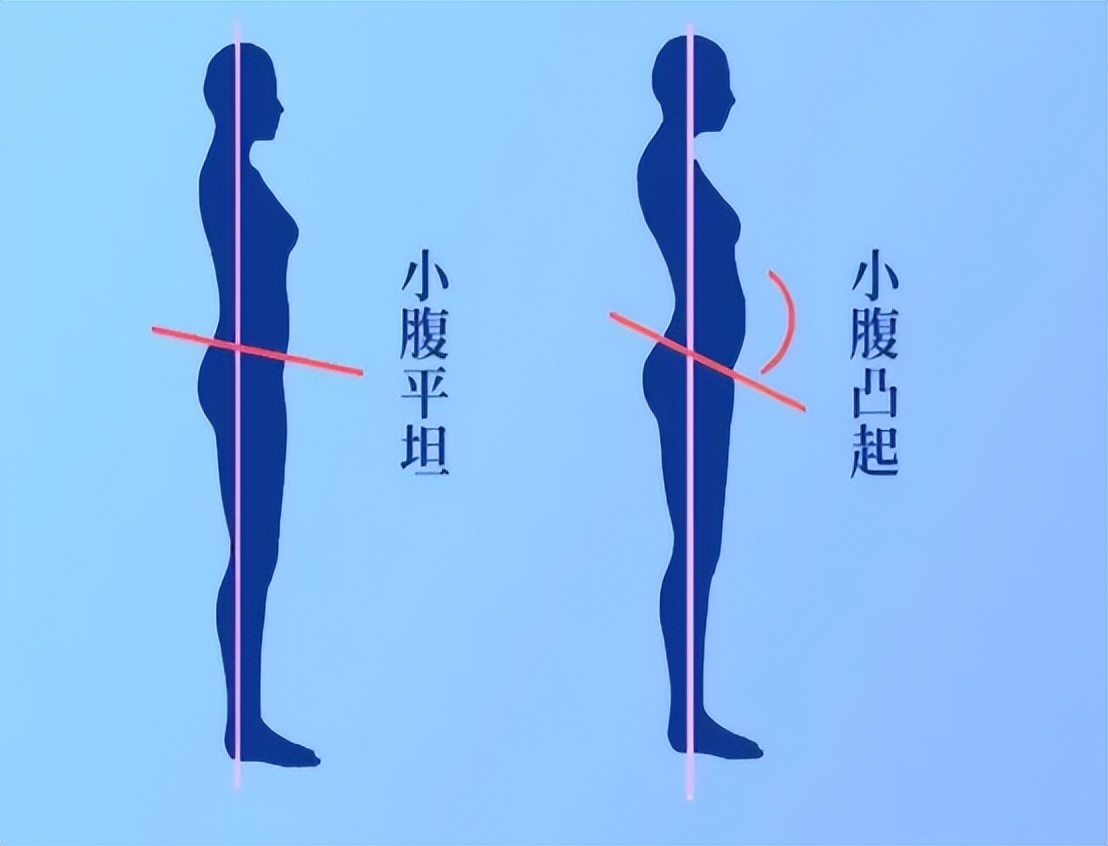 如何区分翘臀与骨盆前倾？（翘臀与骨盆前倾的区别）