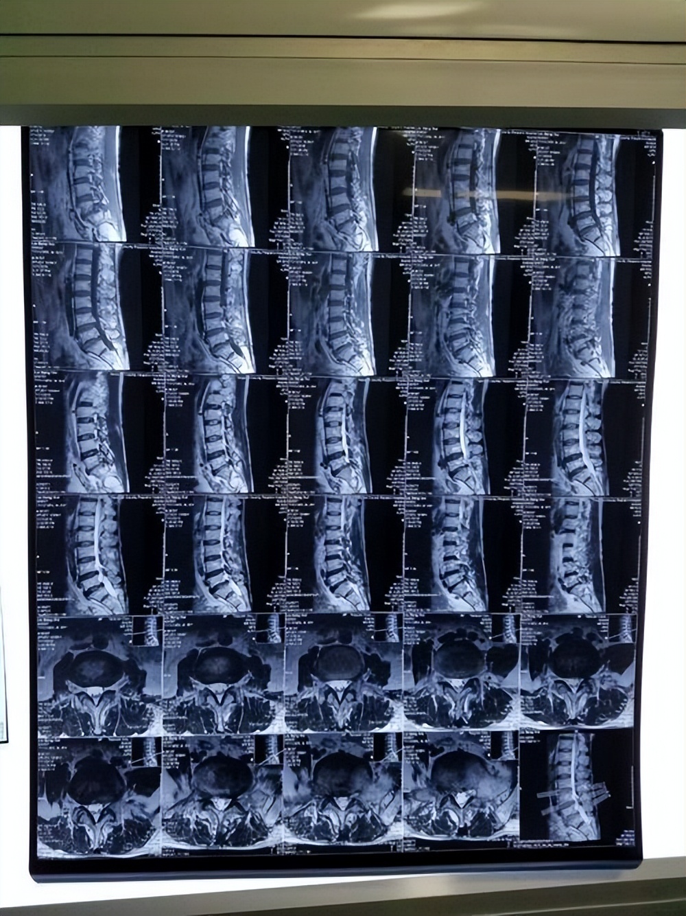 磁共振成像术(mri)也称为核磁共振,其基本原理是在强大磁场的作用下