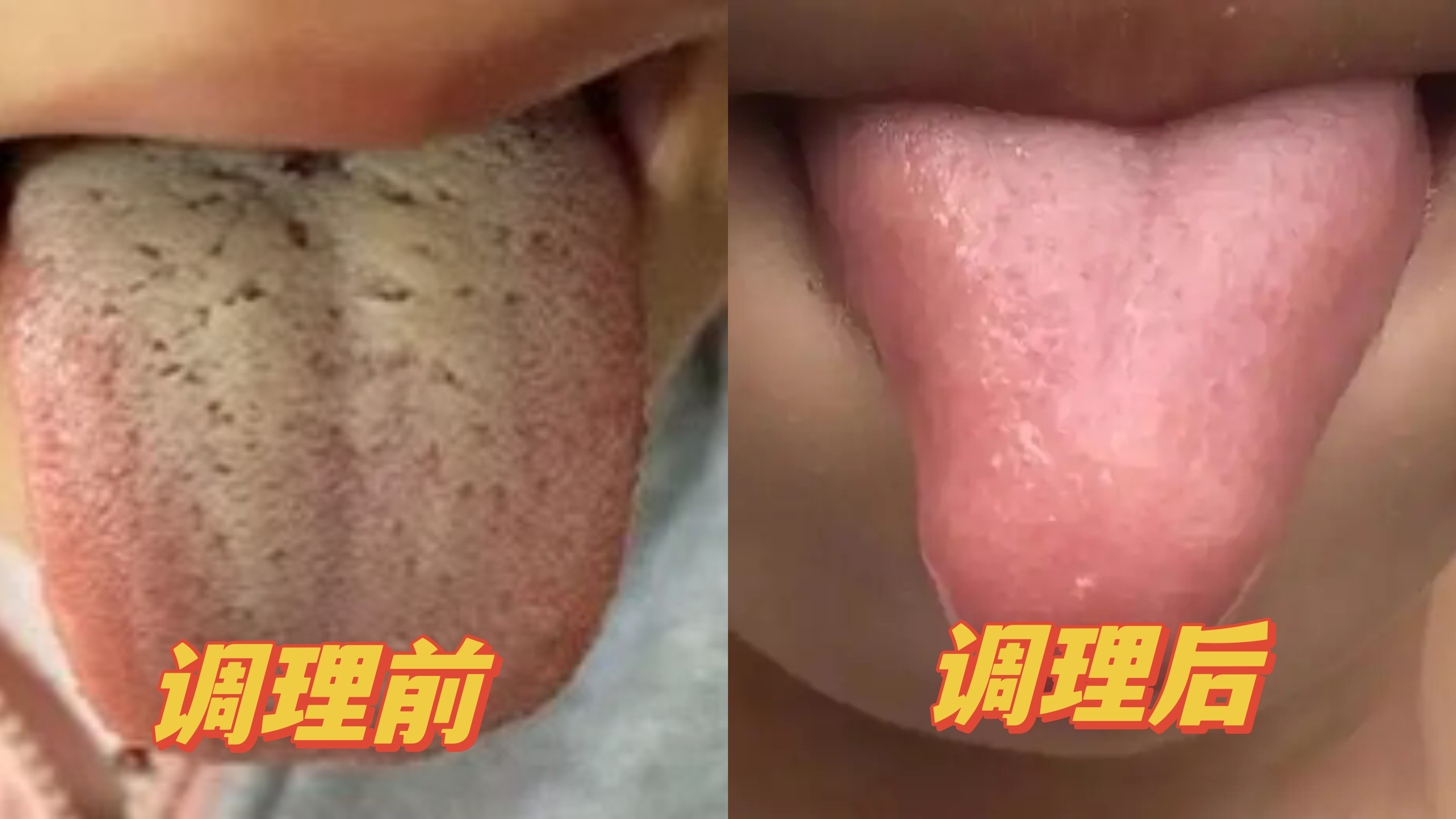 孩子4岁半了，脾胃虚有积食怎么办？