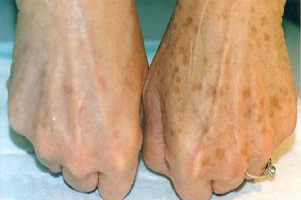 为什么有的人满脸老年斑，有的却干干净净？长老年斑，说明什么？