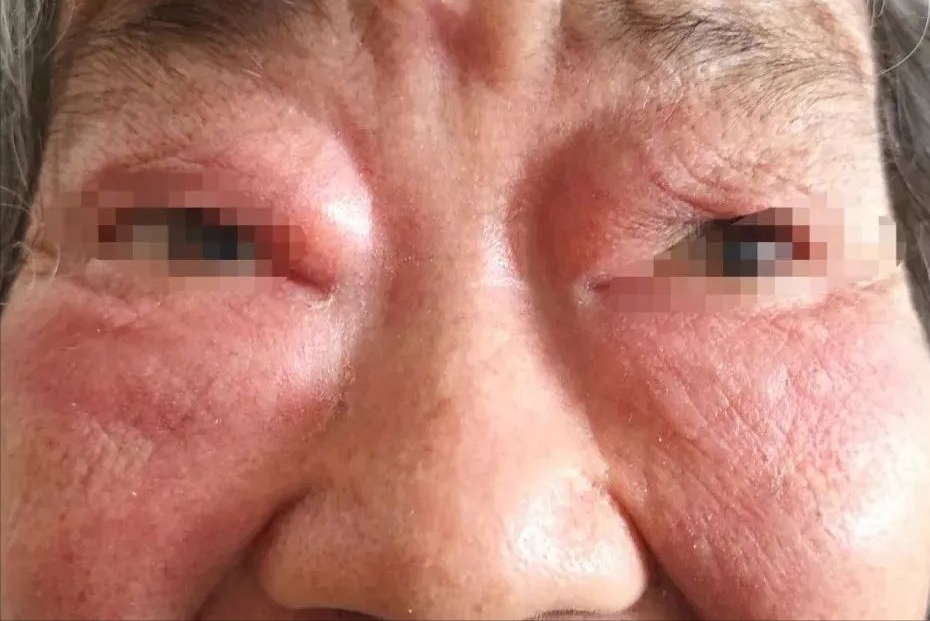 上眼皮神经性皮炎图片(眼睑红肿瘙痒) - 赤虎壹号