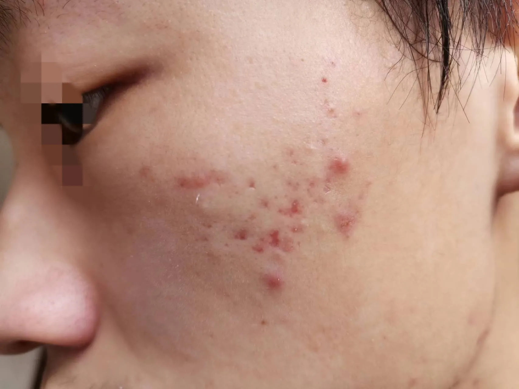 儿童青春痘最好的治疗方法(今天给孩子治疗脸上的痘痘，花了900多元)