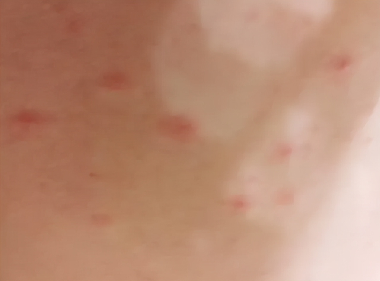 别把艾滋病当成皮肤病？若身体出现3种变化，及早做检查