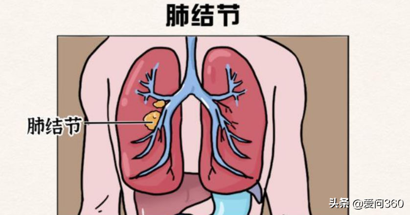 肺结节到底什么原因引发的？了解几个产生的原因，提前避免和预防