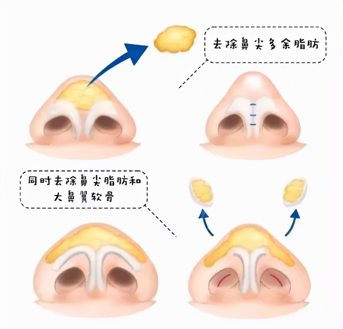 鼻头形态受到哪些因素影响