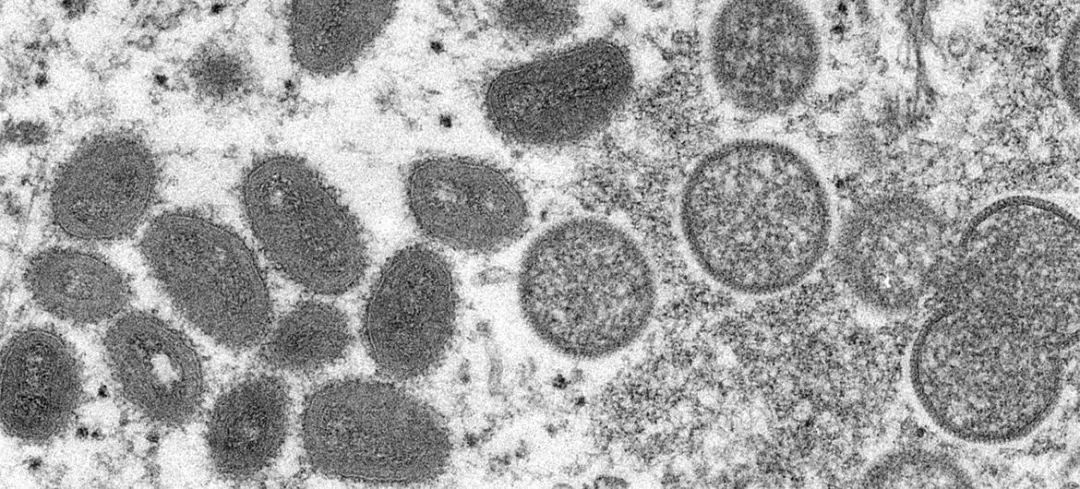 猴痘疫情溯源最新進展，一些預防天花的疫苗也可預防猴痘