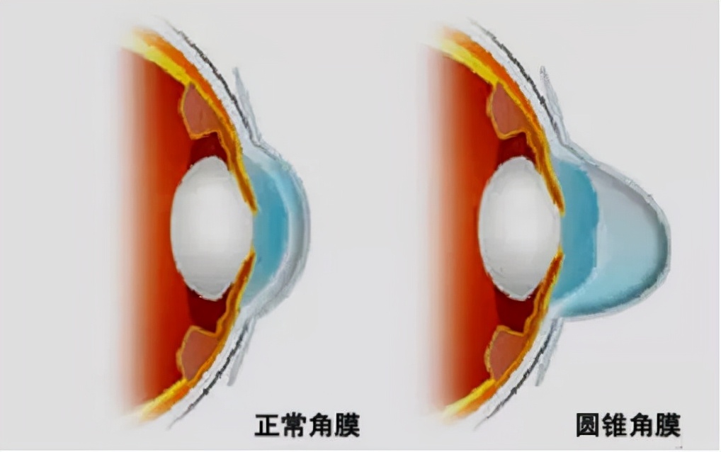 快看看孩子的眼睛！眯眼、流泪、疼痛，很可能隐藏着不可逆的危害