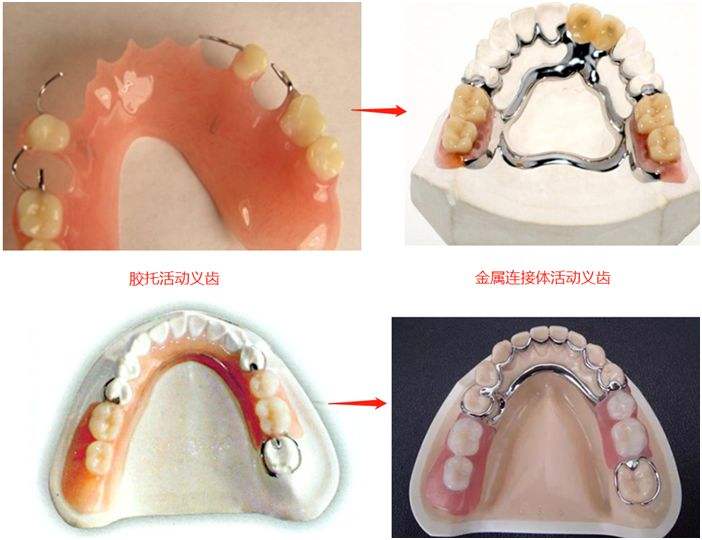 老牙医建议：中老年人使用这3种假牙最实用