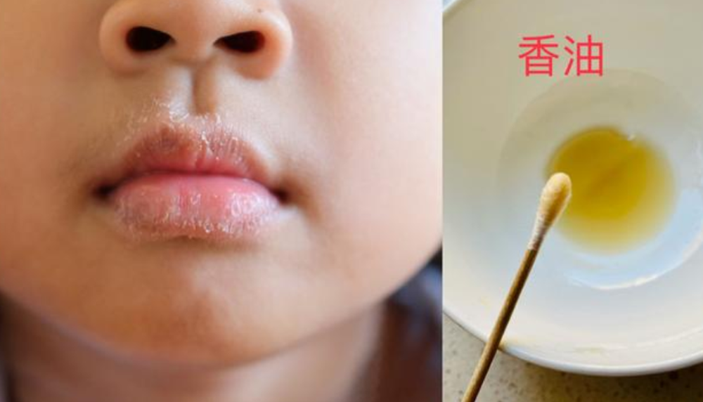 冬季孩子嘴唇干裂起皮，用手撕加重病情，父母要学会双管齐下
