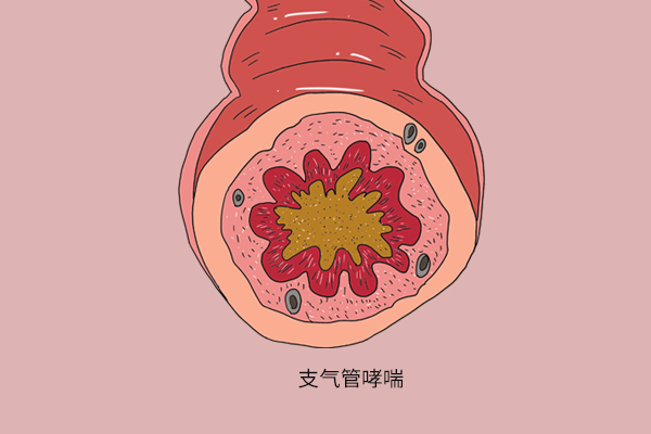 美研究：“四高”食物有利防治哮喘！冬季哮喘易发，学会3招预防