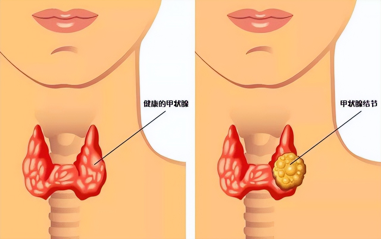 甲状腺癌患者越来越多，和什么原因有关系？