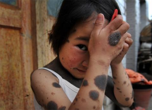 女孩60%皮肤布满黑毛,2岁遭父母抛弃,被同龄人取"小猴子"外号