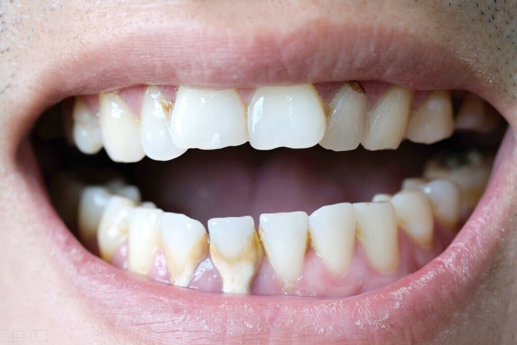 3个症状提醒患有牙周病！提醒：不想掉牙，提前做好3件事