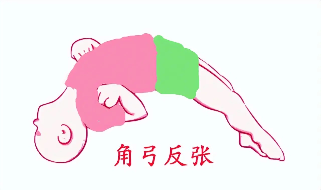 出生2天宝宝能抬头被疑肌张力高，怎么回事？肌张力高怎么判断