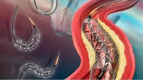 心脏支架术后能做核磁共振检查吗(心脏支架手术以后能不能做核磁共振、CT检查呢？心血)