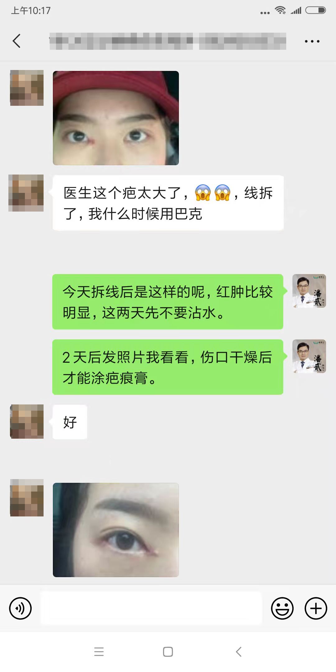 四川女子整容失败：我当初就不应该去开内外眼角，做多了只会变丑