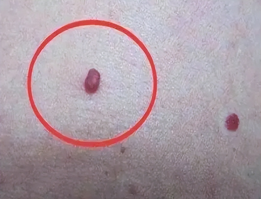 身体突然出现小红点，是疾病来临的信号吗？建议了解