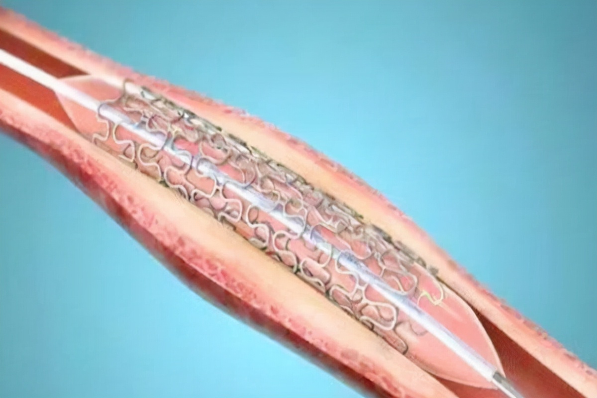 安装心脏支架后,还能活多少年?医生说出大实话,请转告家人