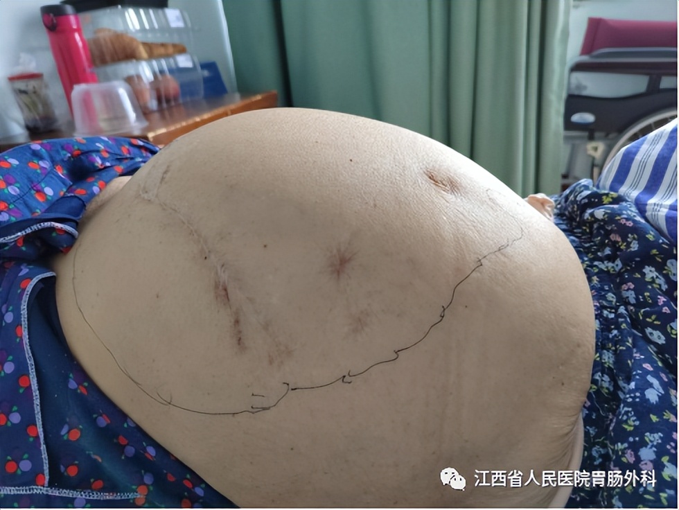 仁医医术| 鲐背老人“拆弹记”