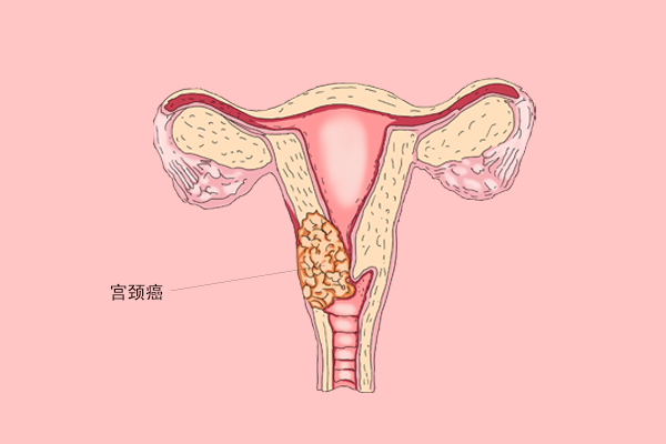 HPV病毒会伪装，不检查很难发现，女性发现4种特征，建议早筛查