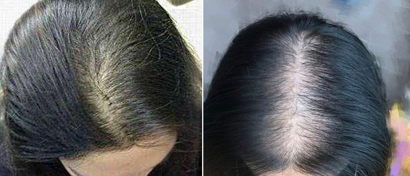 减低男性体内的dht浓度,从而抑制雄激素对头发影响,阻止dht影响下毛囊