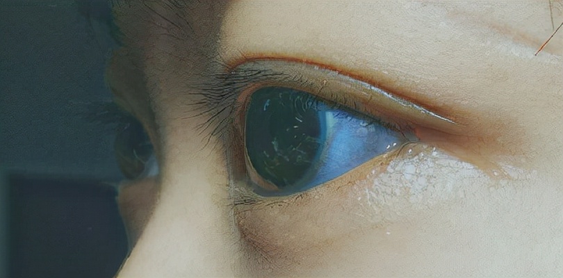 眼白还可能发红,发蓝