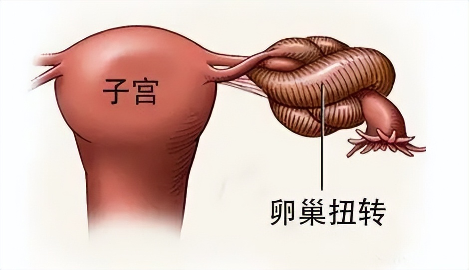 10岁女童腹痛休克，多日无缓解，开腹后医生无奈：系膜转了520°