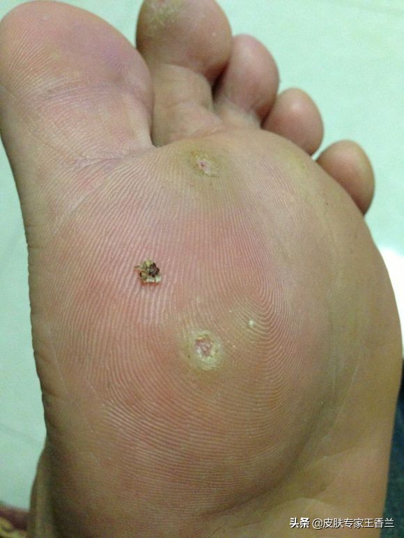 别弄错了,脚底这个结节根本不是鸡眼,当心传染