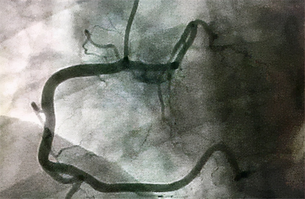 做完冠脉造影，对健康伤害很大？冠脉造影检查对人体有哪些危害？