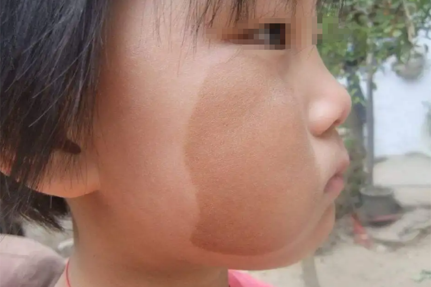 咖啡牛奶斑图片婴儿(宝宝的胎记) - 乐宝宝贝