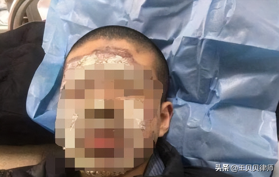 15岁初中生在家长会“玩火”烧伤，家长向学校索赔16万