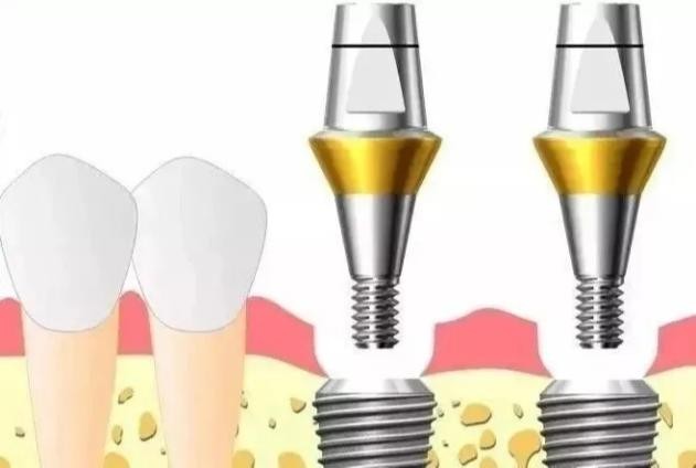 基臺是連接種植體和牙冠的部分,通常情況下種植體上面的基臺都是配套