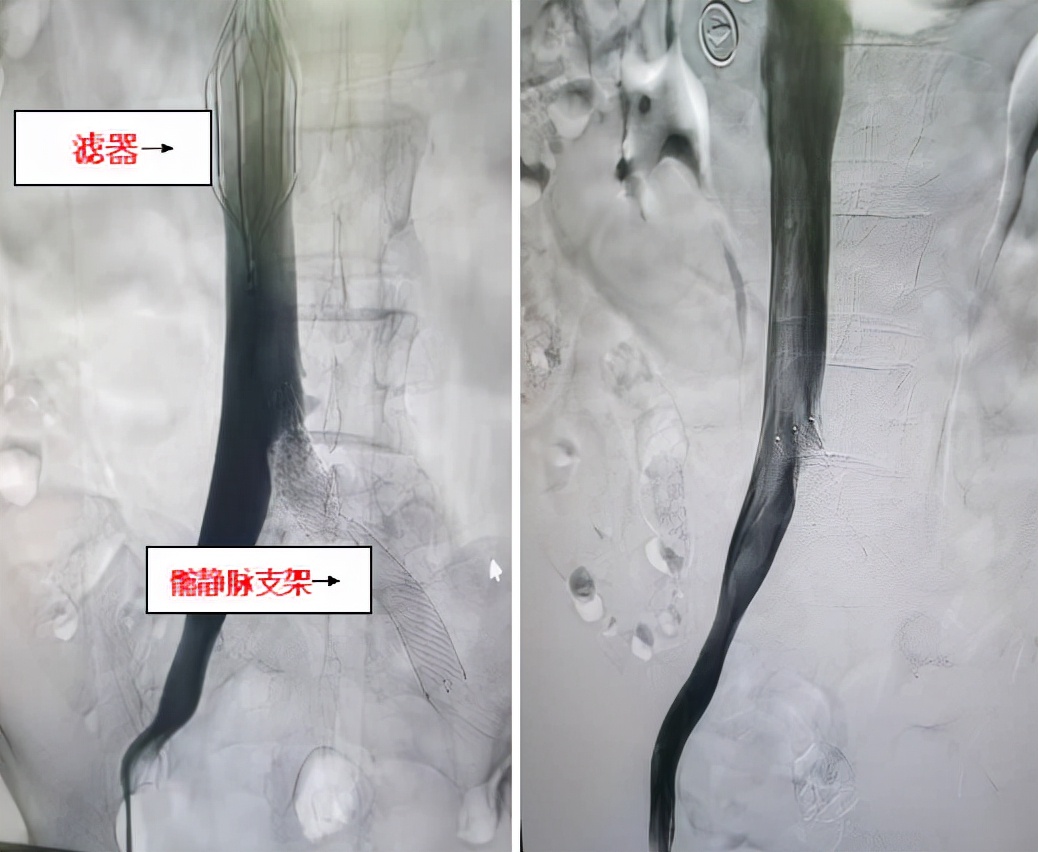 六旬老人下肢疼痛肿胀 一站式介入手术为患者“解围”