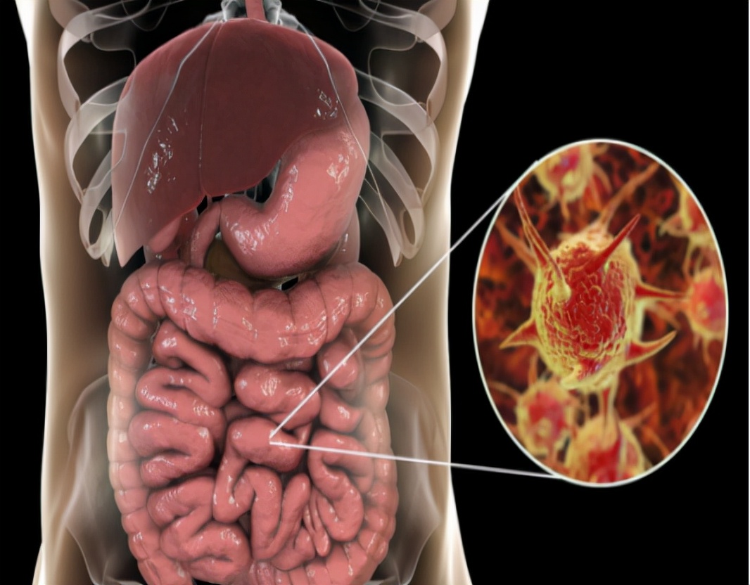 为什么肠道容易长息肉?大多与这4个因素有关,了解下
