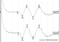 司法鉴定所对高坠伤致头面部损伤的法医临床鉴定