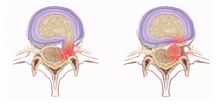 大部分腰椎间盘突出症不用手术？可以用这3类药，做好预防更重要