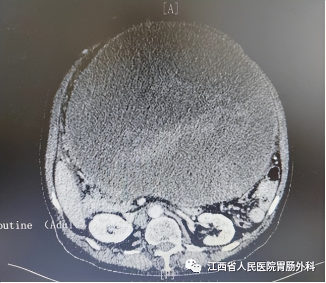 仁医医术| 鲐背老人“拆弹记”