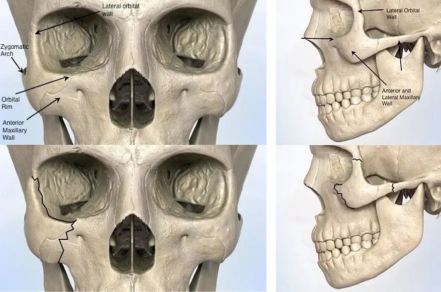 不同的颧骨形态类型，哪些需要改善