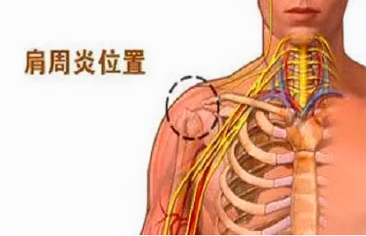 肩周炎到底是怎么回事？三分钟解析清楚