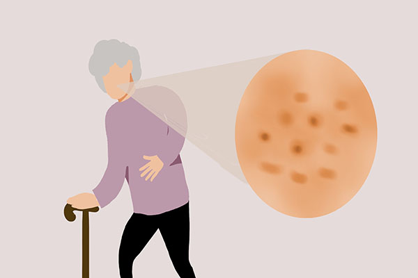 为什么有的人满脸老年斑，有的却干干净净？长老年斑，说明什么？